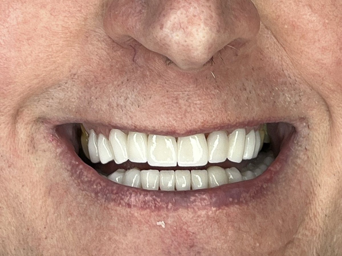Porcelain veneers patient, after