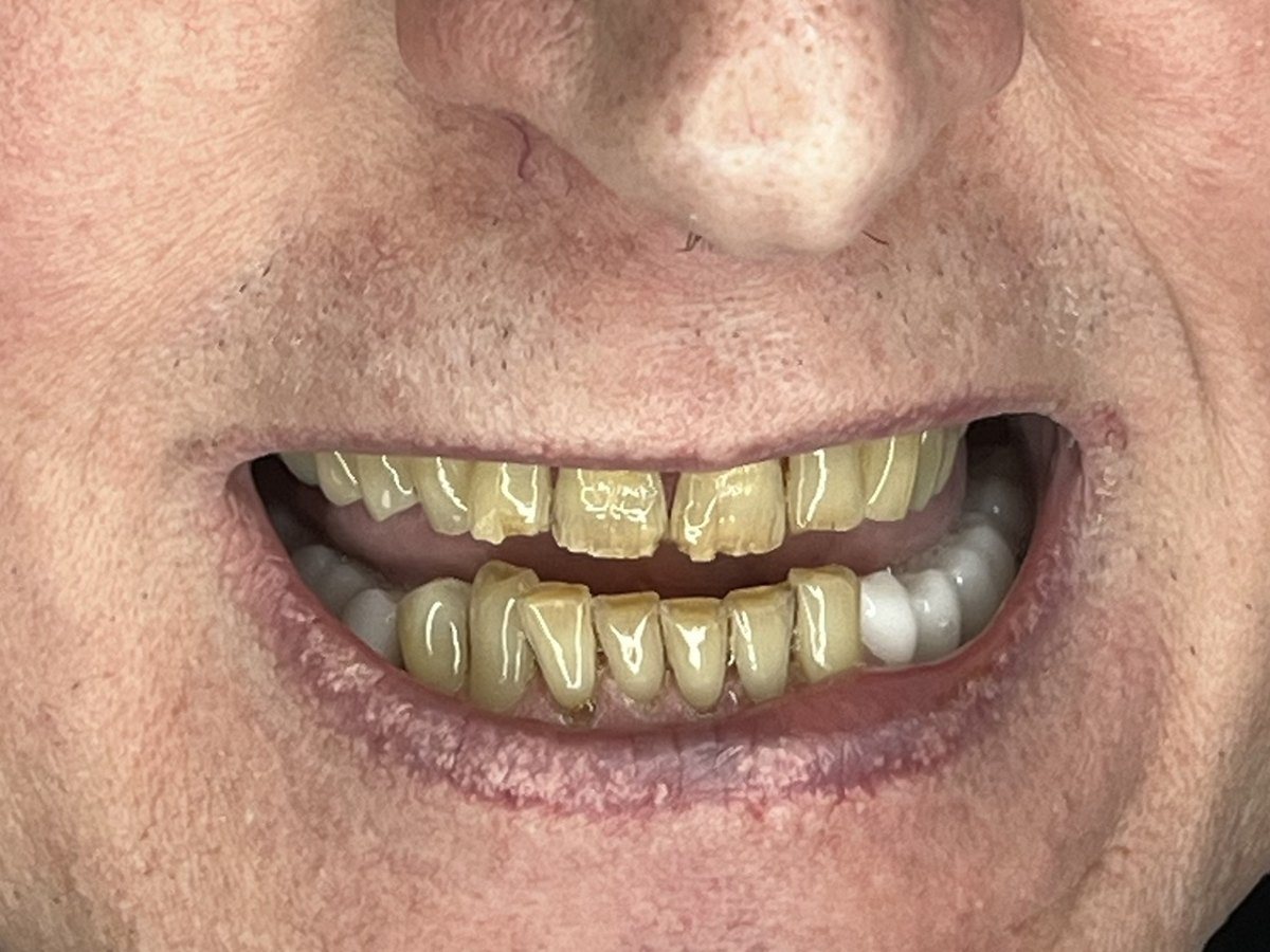 Porcelain veneers patient, before