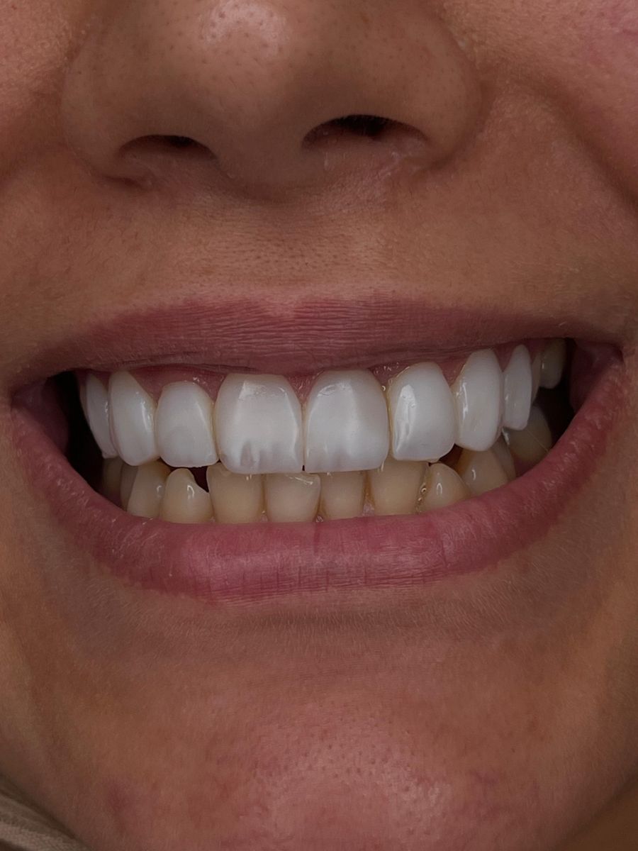 Porcelain veneers case 1, before treatment