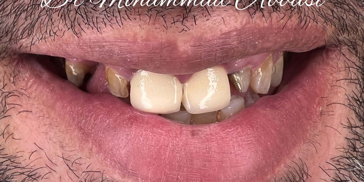 Porcelain veneers case 11, before treatment