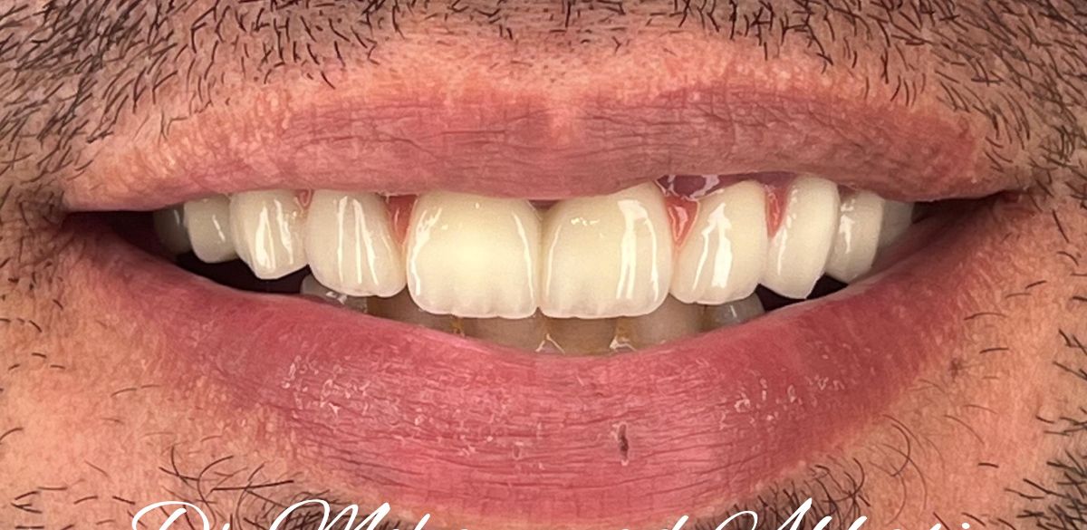 Porcelain veneers case 11, after treatment