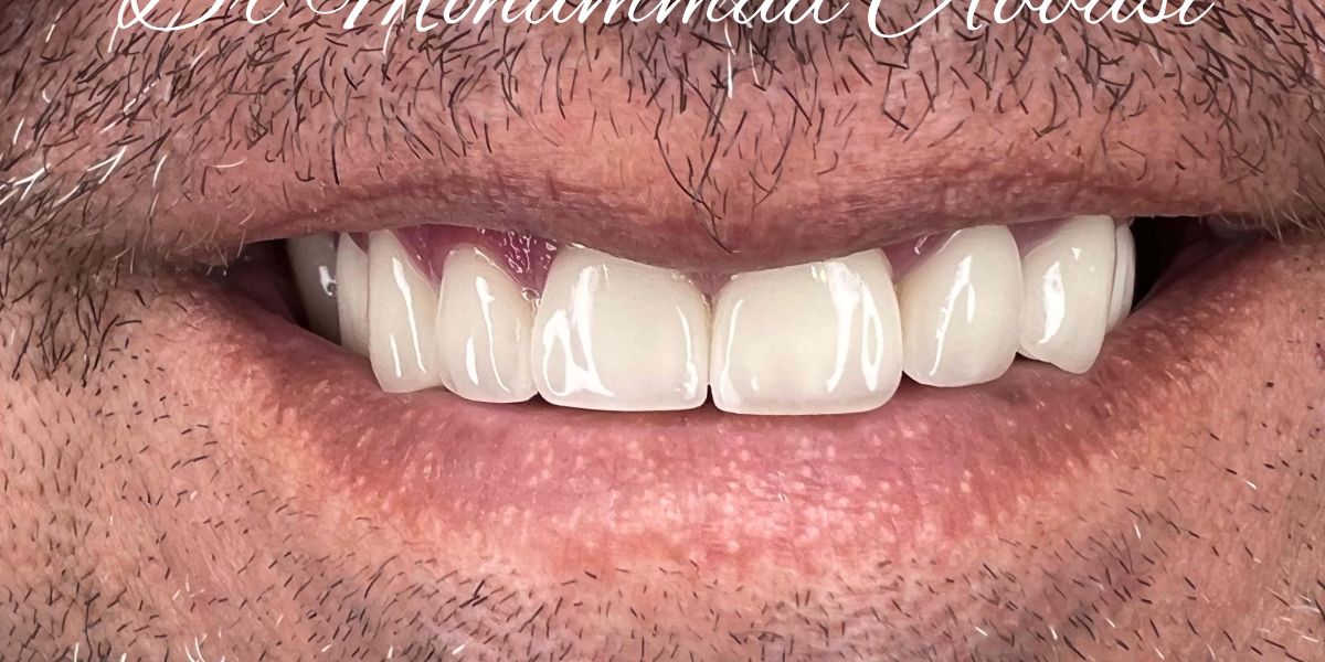 Porcelain veneers case 13, after treatment