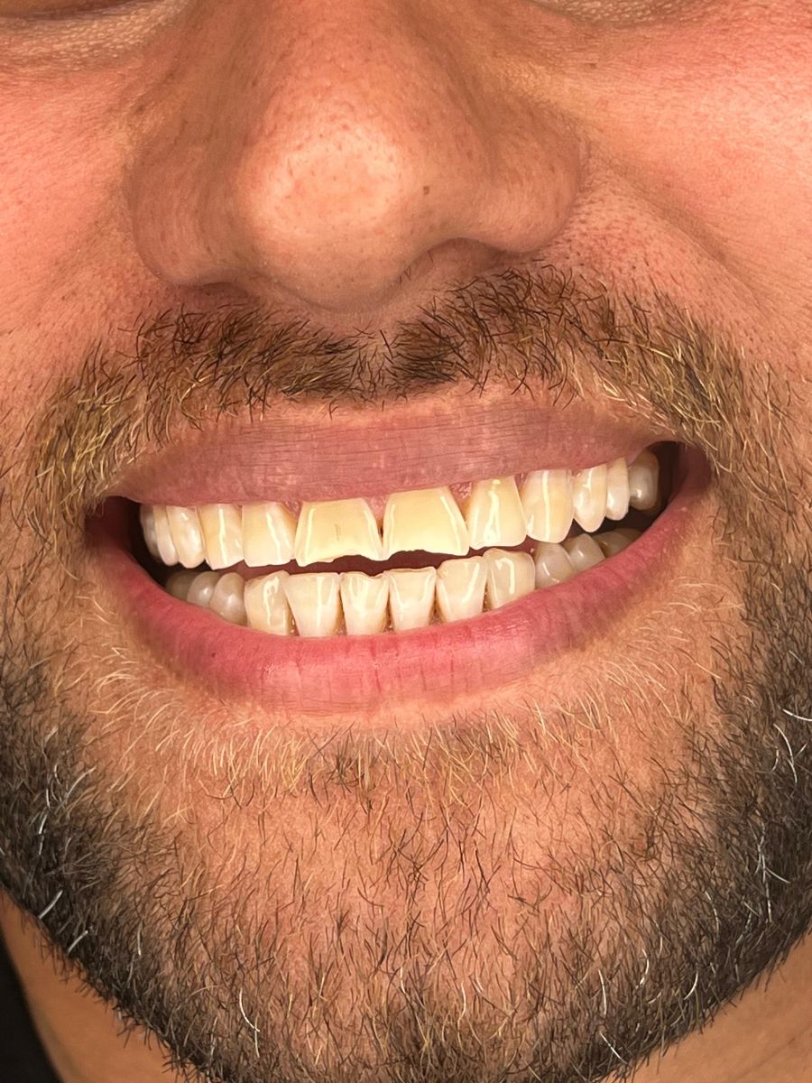 Porcelain veneers case 14, before treatment