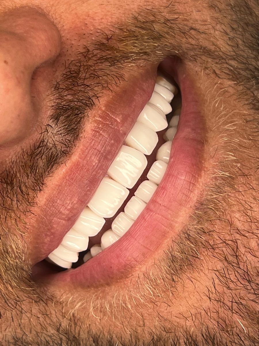 Porcelain veneers case 14, after treatment