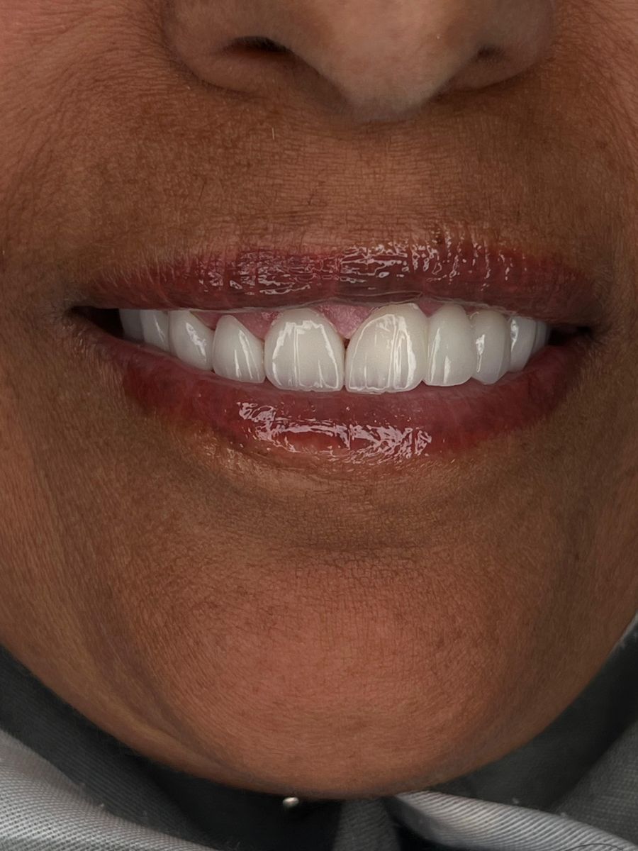 Porcelain veneers case 2, after treatment