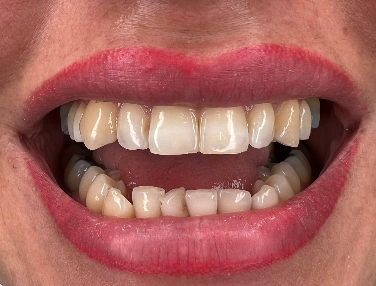 Porcelain veneers case 4, before treatment