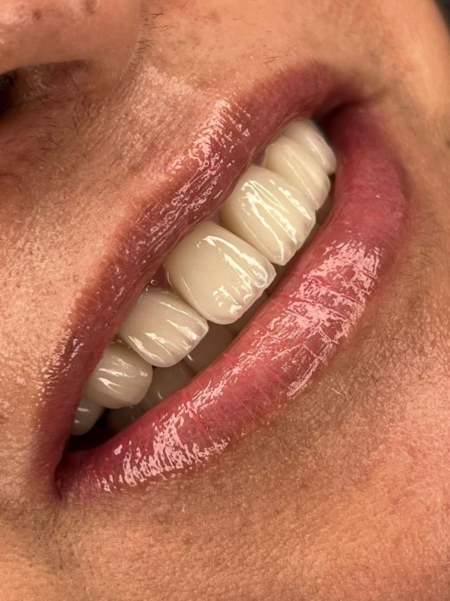 Porcelain veneers result – Dr Abbasi, Dingwall