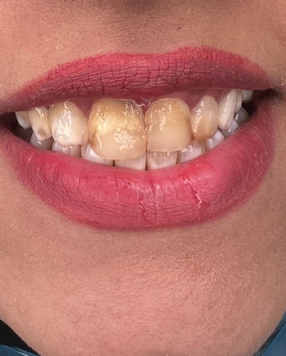 Porcelain veneers case 9, before treatment