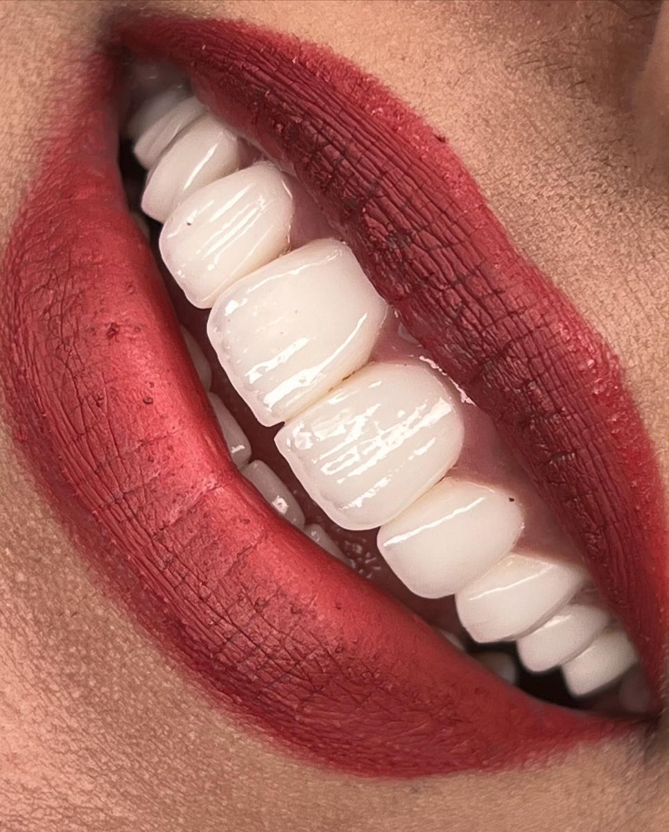 Porcelain veneers case 9, after treatment