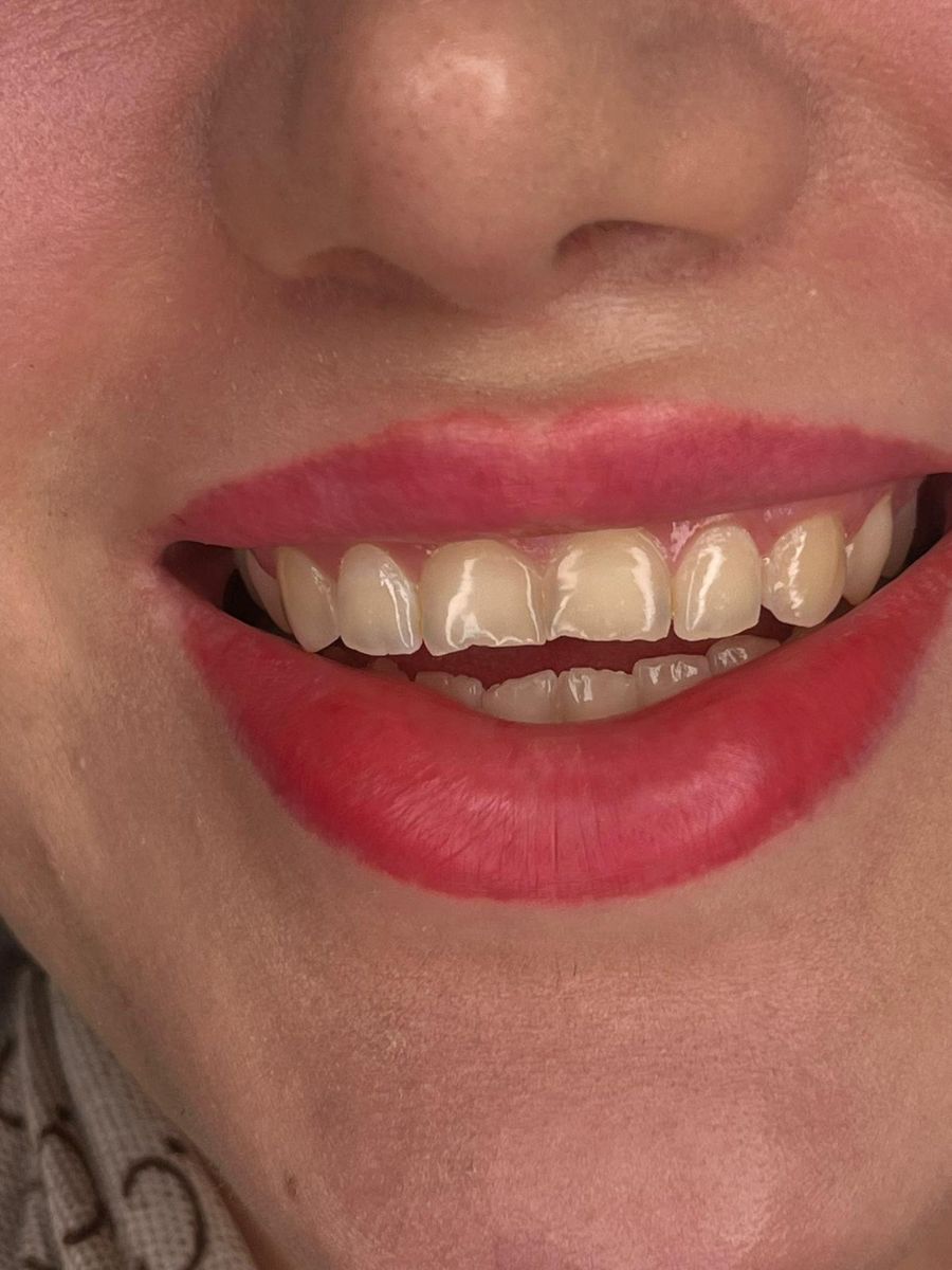 Composite bonding case 1, before