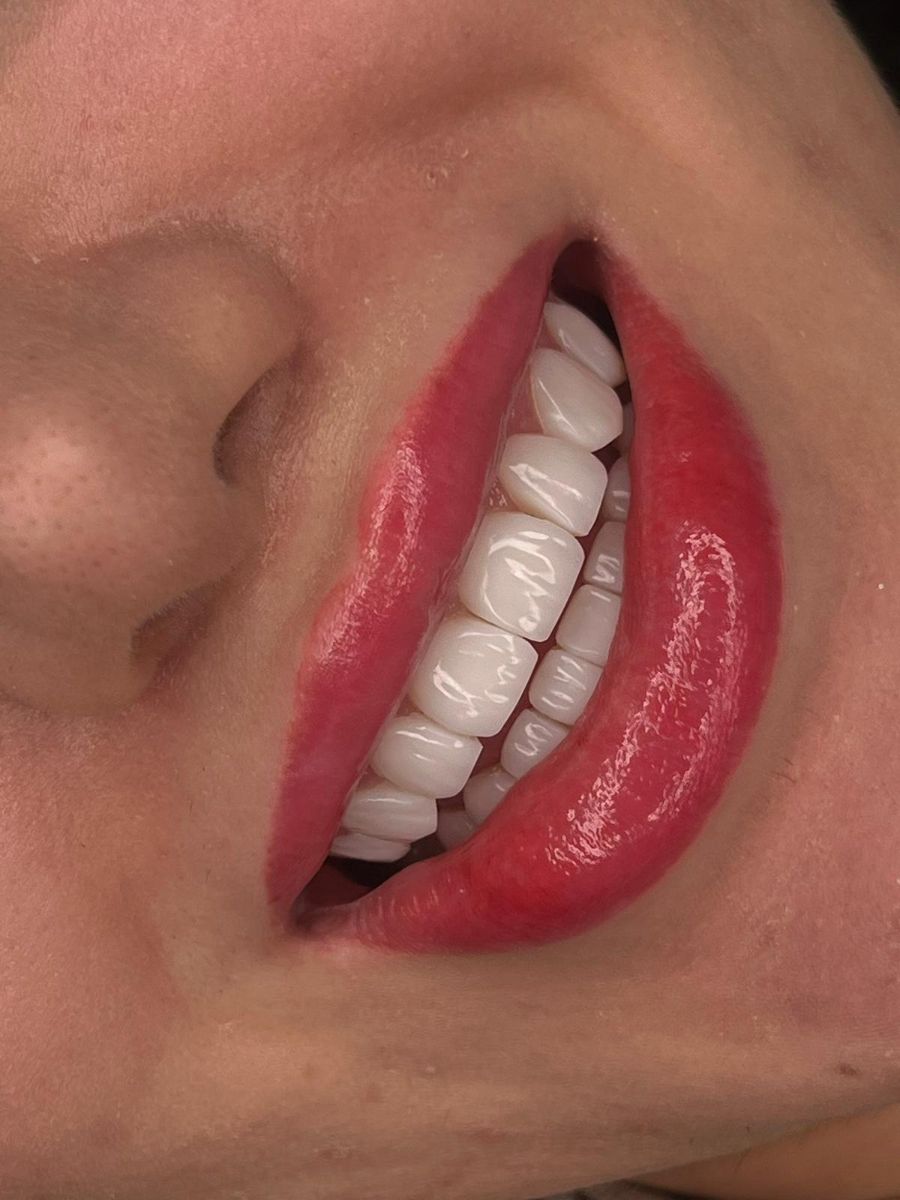 Composite bonding case 1, after