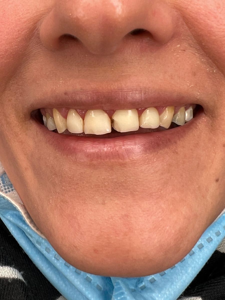 Composite bonding case 2, before treatment