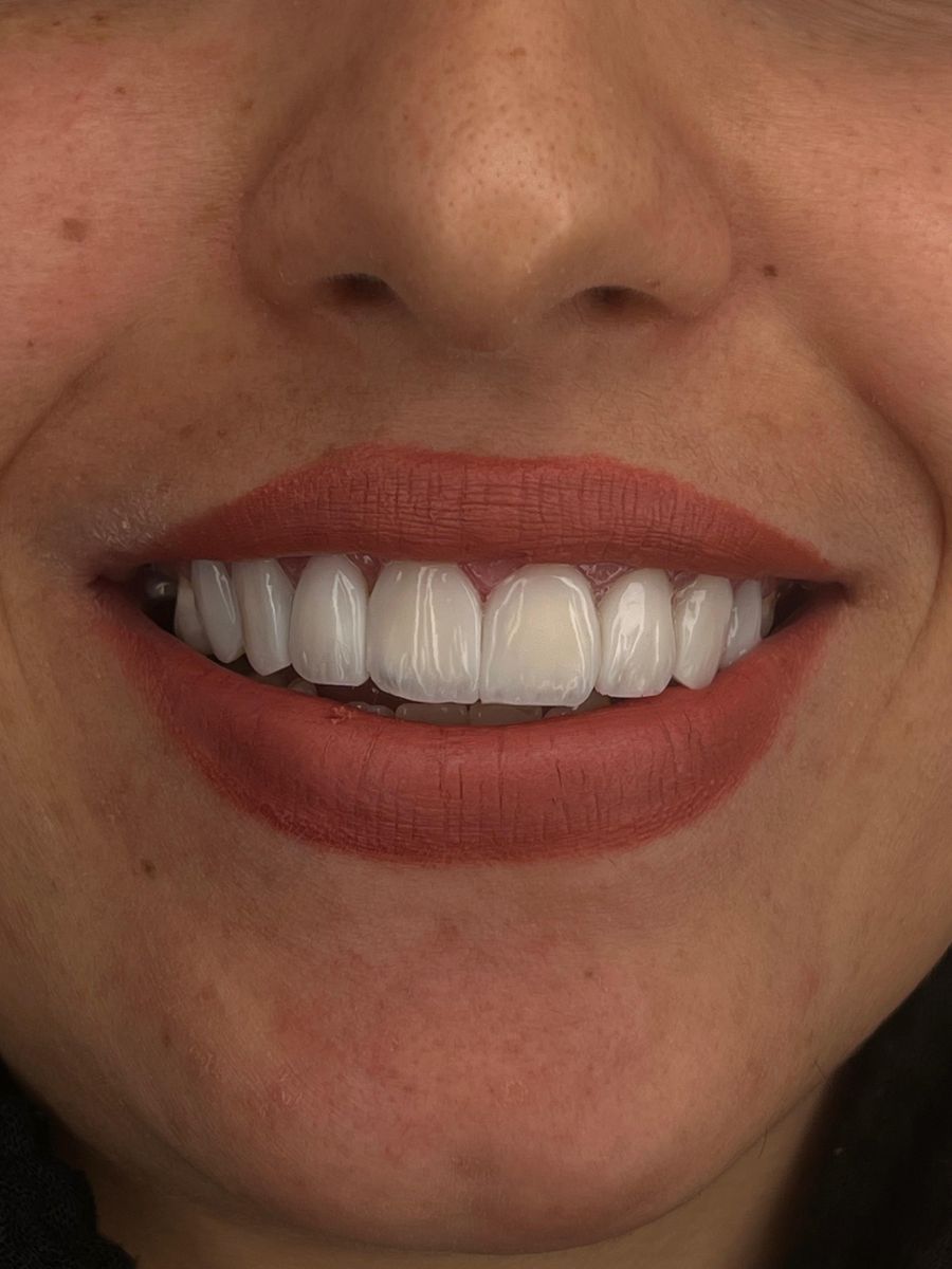 Composite bonding result – Dr Abbasi, Dingwall