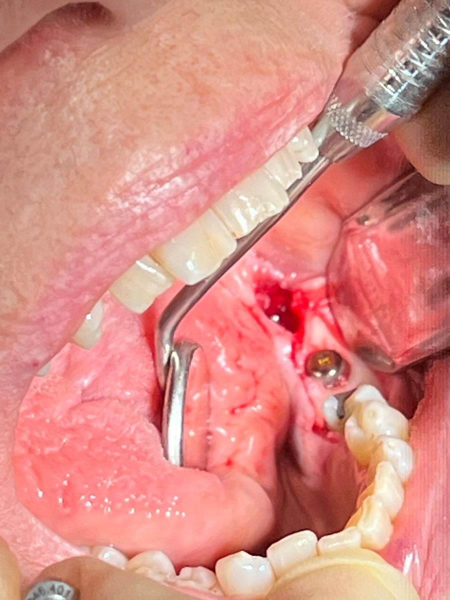 Implant site straight after placement