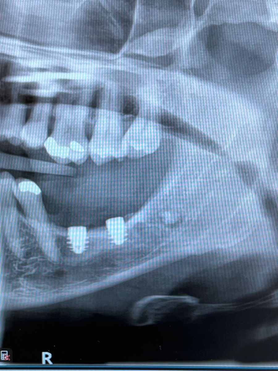 Panoramic X-ray showing the placed implants