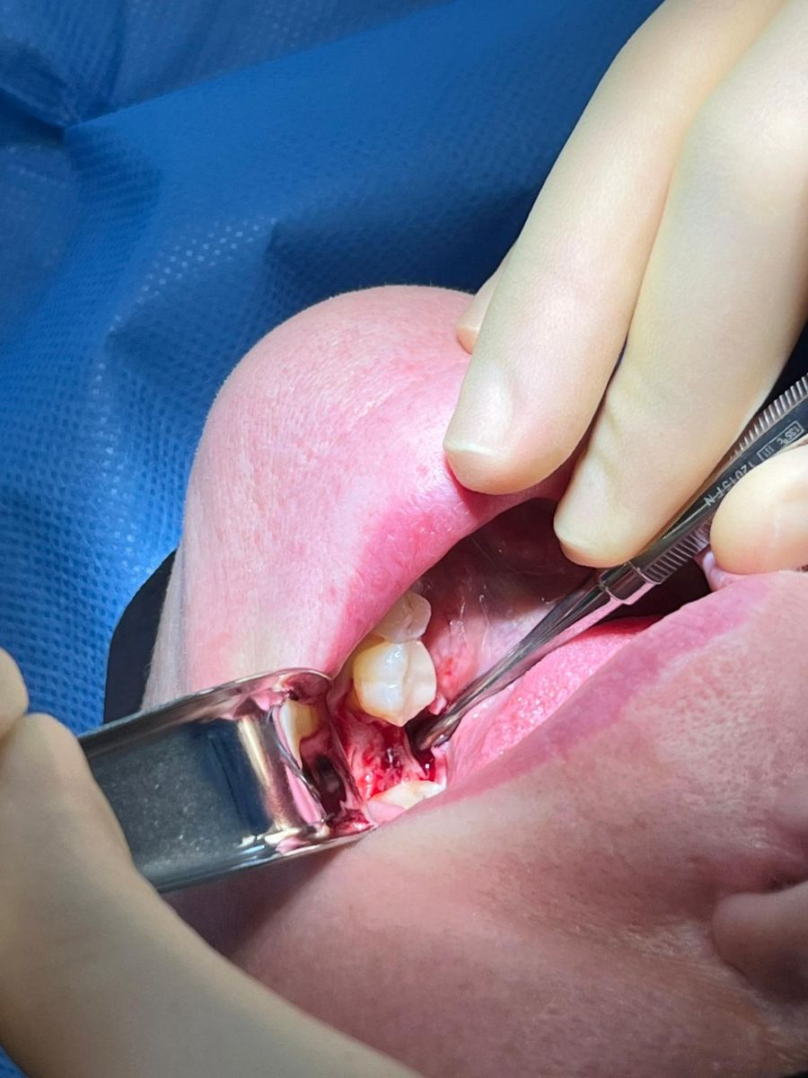 Implant surgery on a real patient