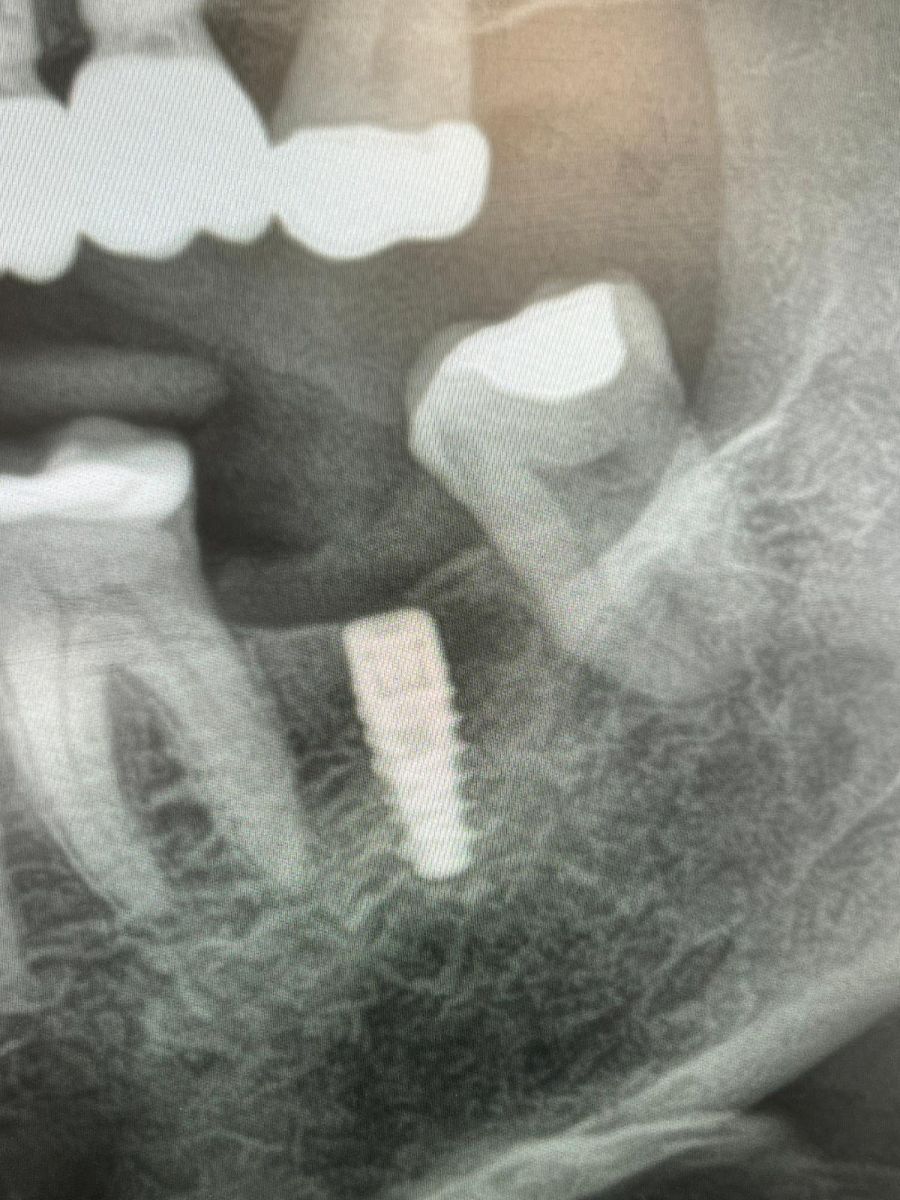 X-ray of the placed implant